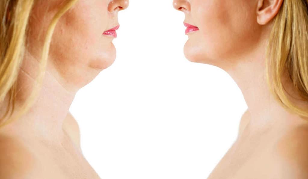 Double Chin treatment Northampton before and after results