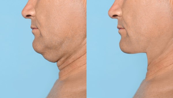 Which Non-Surgical Treatments Work Best for Jowls and Loose Skin Northampton?