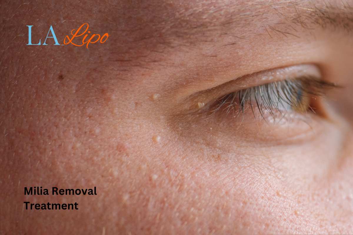 Cryopen Milia Removal: Is It the Easiest and Safest Option Northampton?