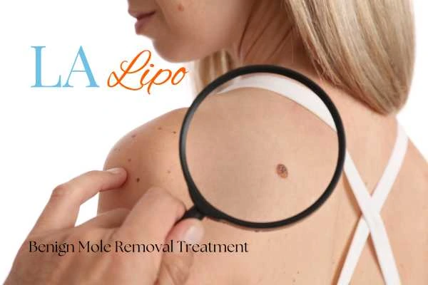 Why getting moles removed Northampton can boost your confidence!