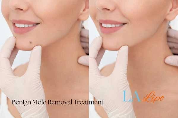 woman's before and after mole removal Northampton results