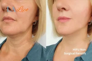 hi-fu for wrinkles Northampton before and after results