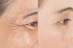 Before and after results of woman - HI-fu wrinkles reduction treatment Northampton