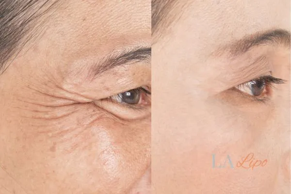 Before and after results of woman - HI-fu wrinkles reduction treatment Northampton
