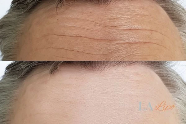 results of HIFU Northampton on mans forehead to help reduce lines and wrinkles