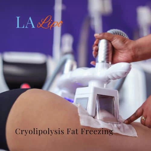 fat freezing - Cryolipolysis Northampton
