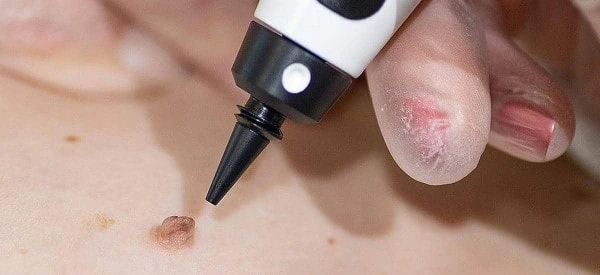 skin tag removal using cryopen Northampton