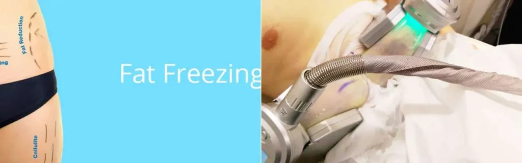 multi areas of a persons body having coolsculpting Northampton treatment