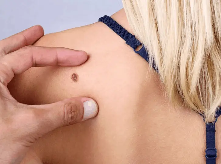 woman having mole removal Northampton consultation before treatment.