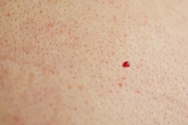 close up of a cherry angioma Northampton