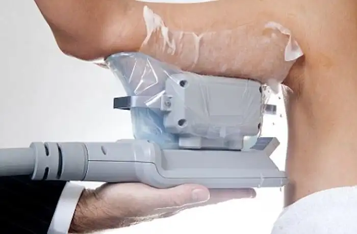 Picture of fat freezing Northampton on the upper arms.