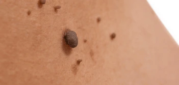 image of a skin tag Northampton