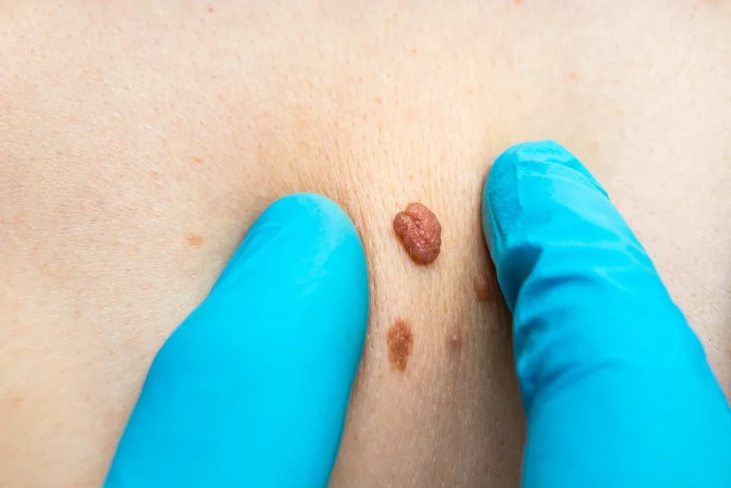 Consultant examining a skin tag Northampton