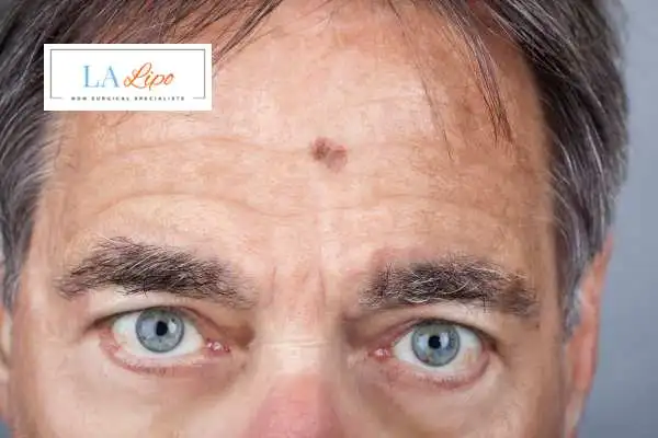 Solar Lentigo Removal Northampton image of man with mark on his forehead