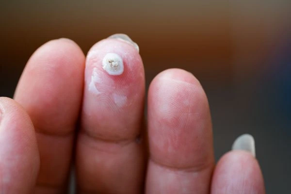 wart on person finger - cryotherapy to treat from LA LIPO Northampton
