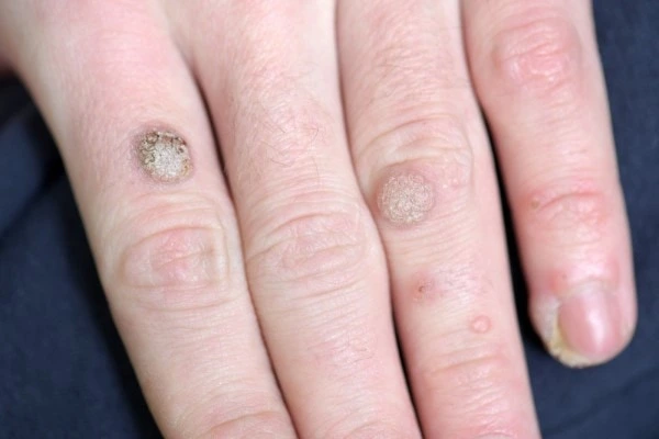 photo of warts on person hand - see wart removal Northampton from LA LIPO