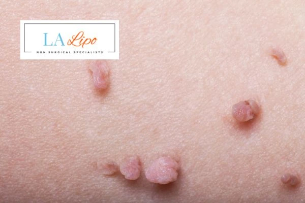 Does cryopen skin tag removal Northampton hurt? Find out now call our team today!