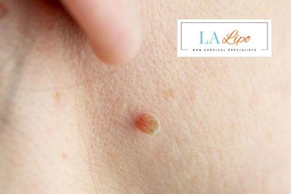 Book skin tag removal Northampton today speak to our team now!