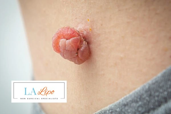 Interested in skin tag removal Northampton? Concerned about the pain? Find out more today!