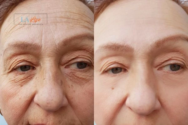 The powerful benefits of Morpheus8 Treatment Northampton - Call Our team today!