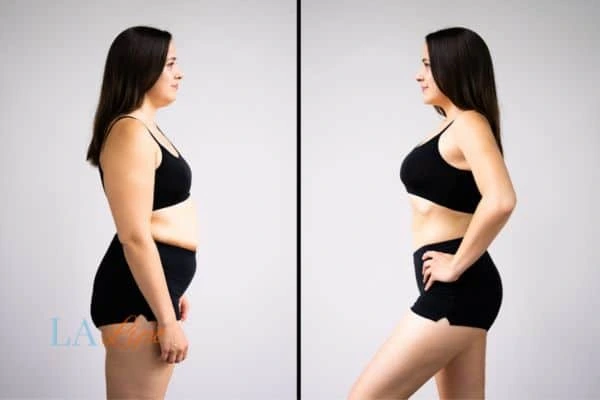 Picture of womans before and after using LA-EMS body sculpting to improve her core strength Northampton