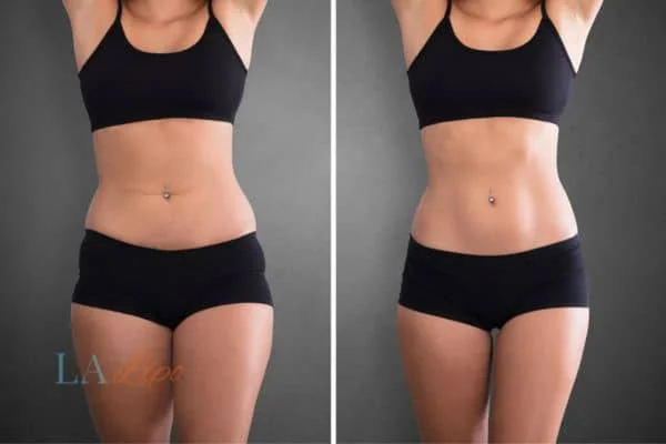 before and after results of non-surgical treatment to help a woman's body image and mental health Northampton