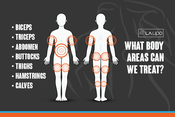 Diagram to show areas you can have LA-EMS Body Sculpting Treatment Northampton