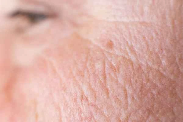 close up picture of a woman's face showing an age spot Northampton