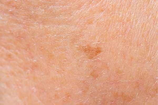 close up picture of age spots Northampton