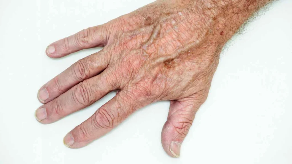 Male hand showing age spot Northampton