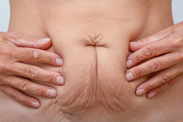 Image of a woman's stomach with loose skin - example of skin tightening Northampton options