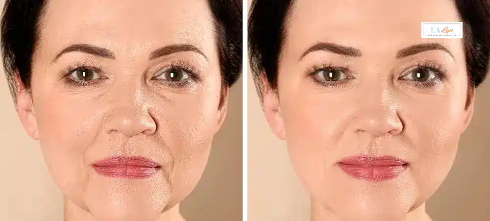 How Long Does It Take to See Results and How Long Do They Last Northampton?