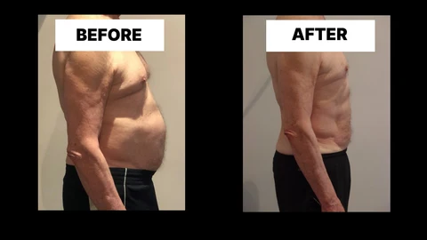 What Symptoms Can Diastasis Recti Cause in Men? Weak Core, Back Pain and Poor Posture Northampton